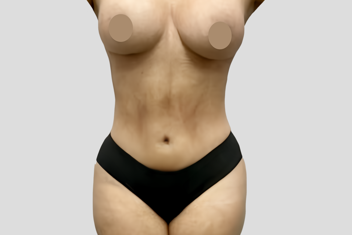 AFTER FRONT 360 liposuction with breast augmentation E. FLOREZ
