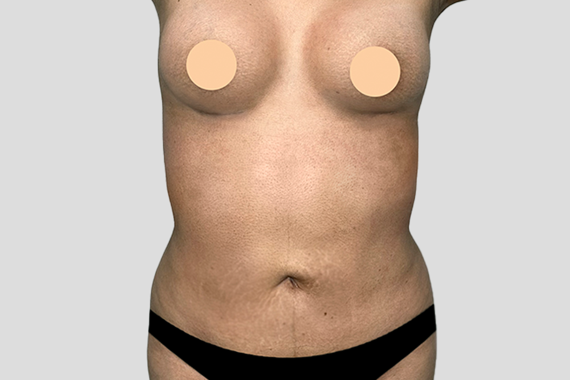 After-BREAST AUGMETATION