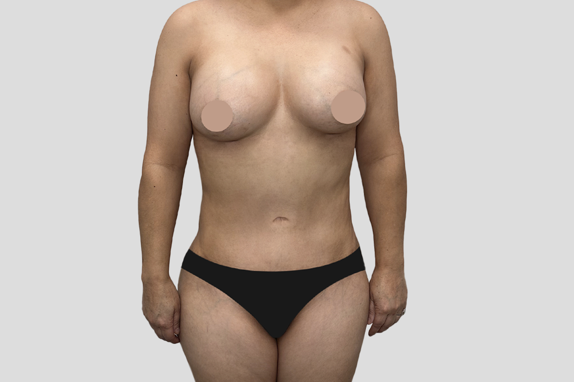 After-TUMMY TUCK