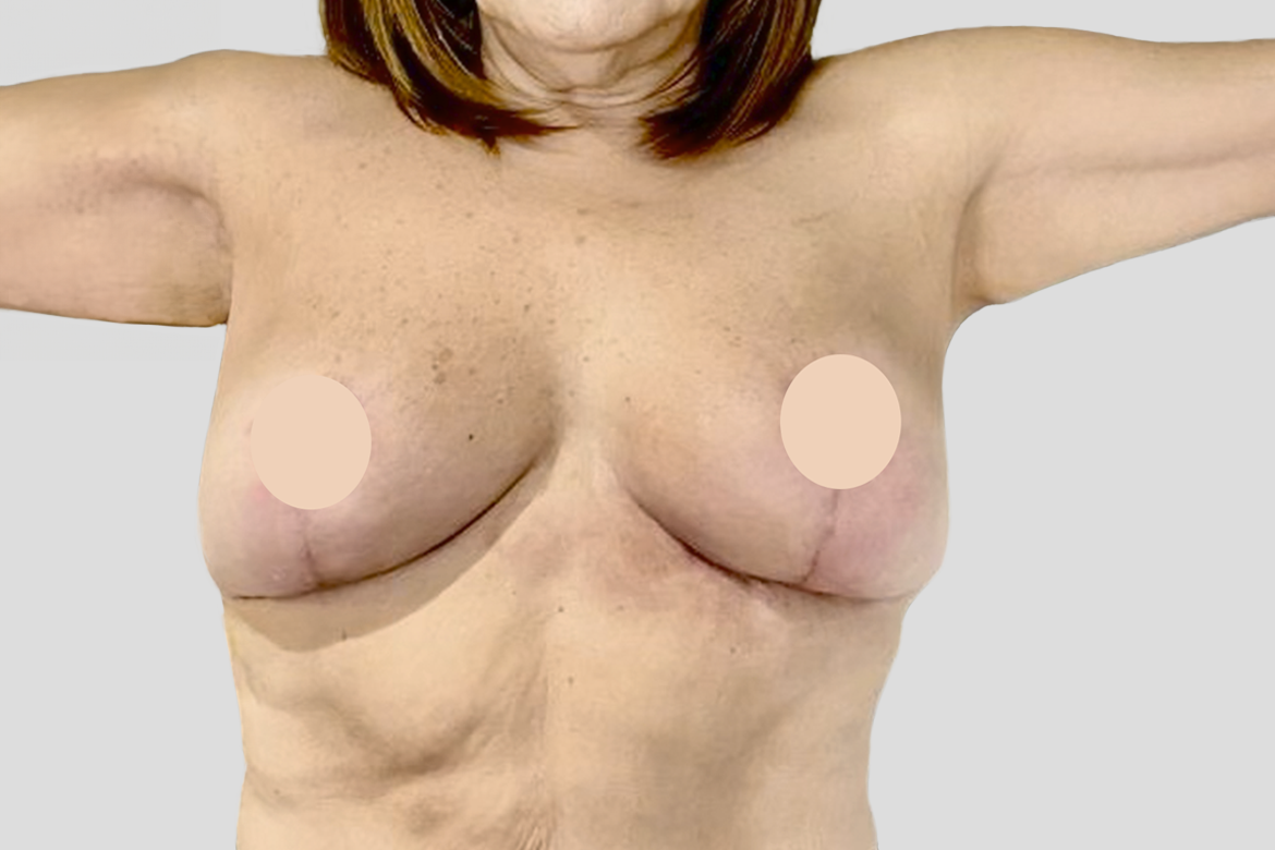 After-EXPLANTATION, LIFT AND FAT TRANSFER TO THE UPPER PART OF THE BREASTS