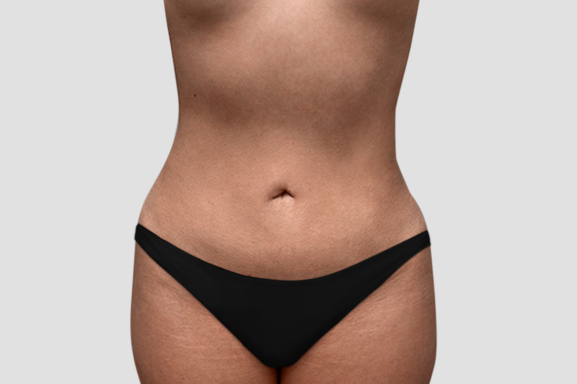After-LIPO + BBL
