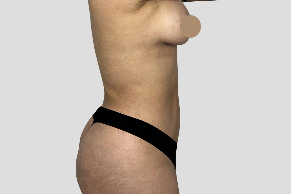 AFTER SIDE 360 liposuction with breast augmentation E. FLOREZ