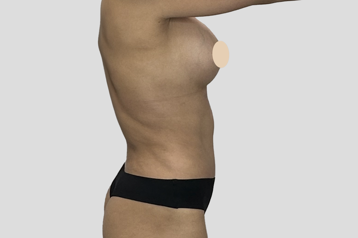 After-IMPLANT EXCHANGE + TUMMY TUCK