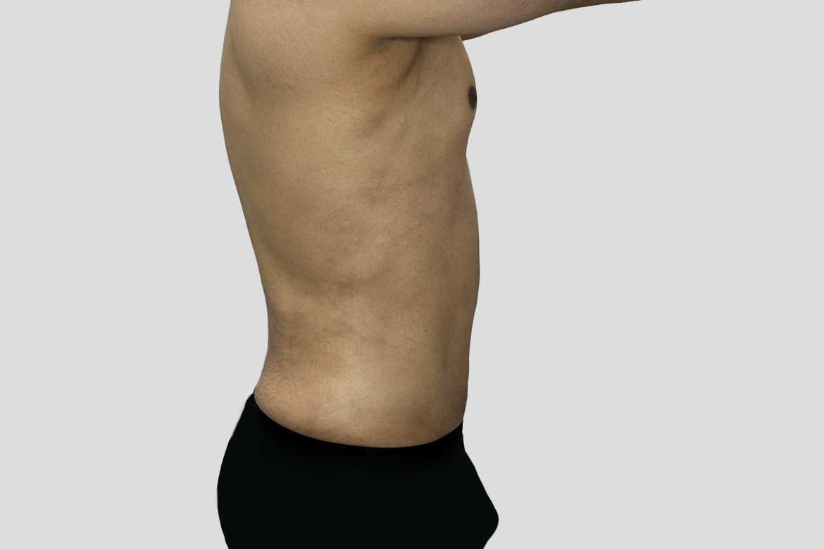After-GYNECOMASTECTOMY + TUMMY AND LOWER BACK LIPOSUCTION