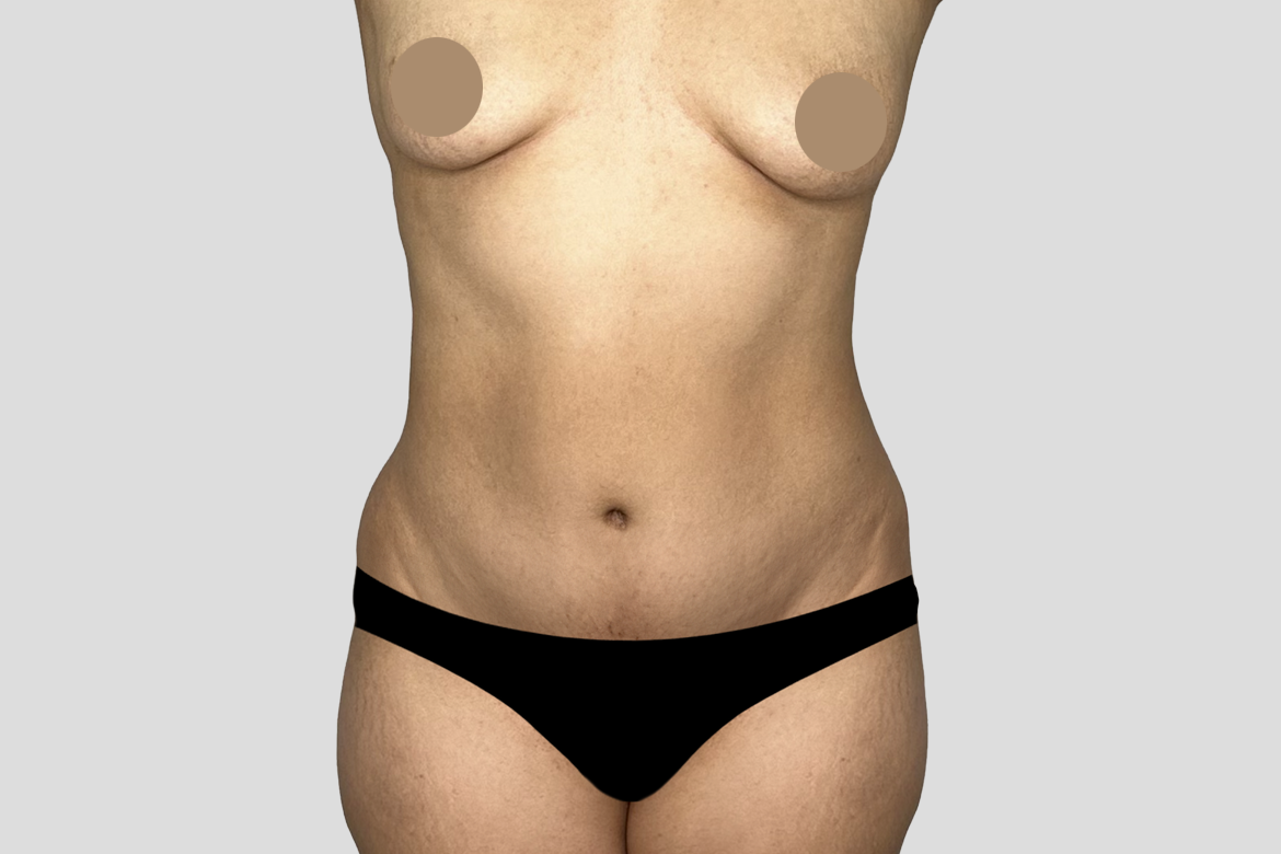BEFORE FRONT 360 liposuction with breast augmentation E. FLOREZ