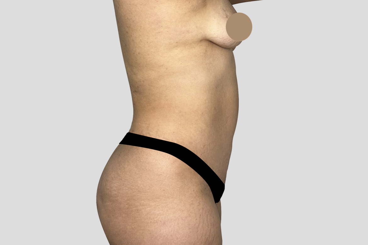 BEFORE SIDE 360 liposuction with breast augmentation E. FLOREZ