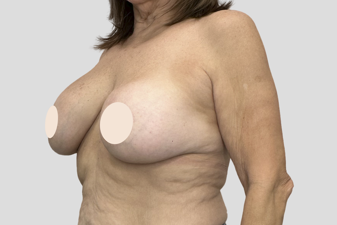 Before-EXPLANTATION, LIFT AND FAT TRANSFER TO THE UPPER PART OF THE BREASTS