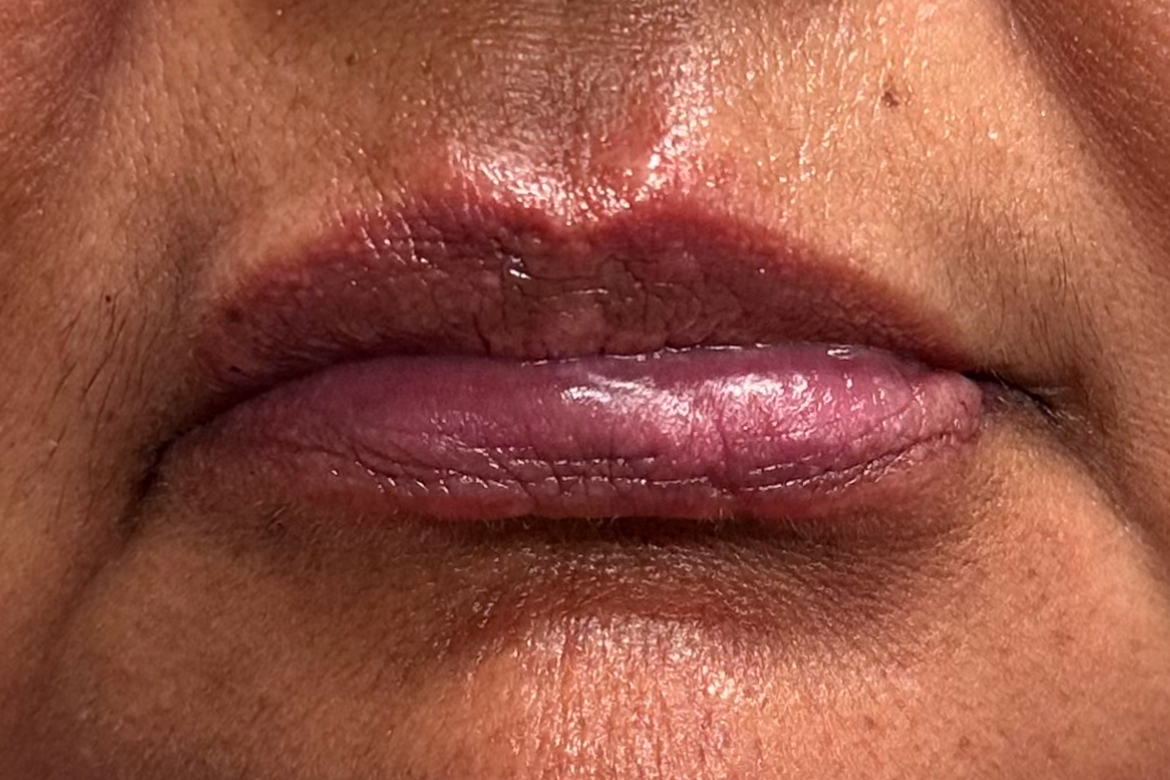 After-LOWER LIP AUGMENTATION