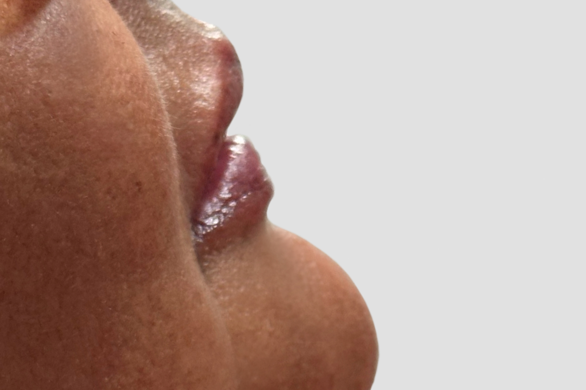 After-LOWER LIP AUGMENTATION